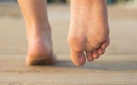 Image result for Arch Collaps Feet