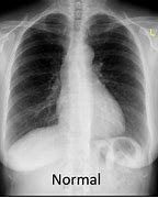 Image result for Chest X-Ray Lungs