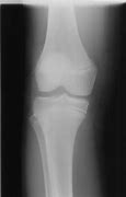 Image result for X-ray of Leg with Metal Plates