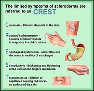 Image result for Scleroderma Puffbals