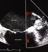 Image result for Left Atrial Appendage Thrombus On Toe