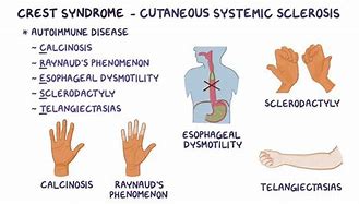 Image result for Ernest Syndrome