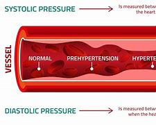 Image result for High Blood Pressure Arteries