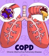 Image result for Best Treatment for COPD Illustration