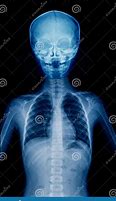 Image result for Thumb X-ray Child