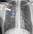 Image result for Chest X-ray of TB