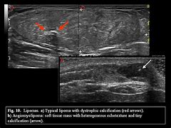 Image result for Hemangioma Ultrasound