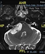 Image result for Vestibular Schwannoma Gross Pathology