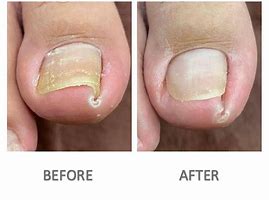 Image result for Ingrown Nail