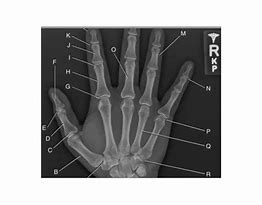 Image result for Normal Hand Radiograph