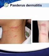 Image result for Fungi Bites and Stings