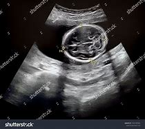 Image result for Head Circumference 37 Weeks Ultrasound