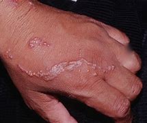 Image result for Poison Ivy Rash African American