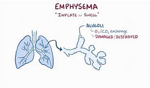 Image result for COPD Emphysema