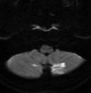 Image result for Diffusion MRI