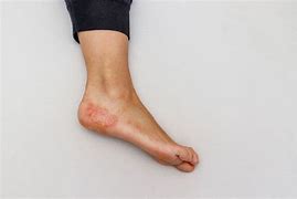 Image result for Best Treatment for Dyshidrotic Eczema