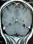 Image result for Coronal Plane Brain MRI