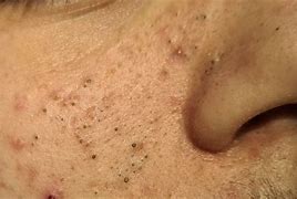 Image result for Pimples and Blackheads On Face