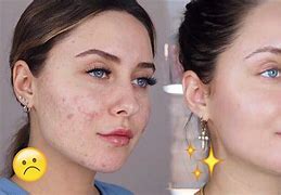 Image result for Acne Scars Home Remedy