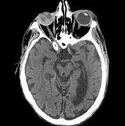 Image result for Orbital Hemorrhage CT