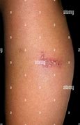 Image result for Lower Leg Pustules