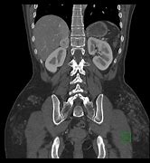 Image result for Light Bulb Sign Pheochromocytoma