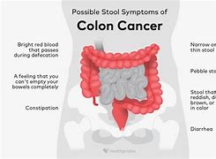 Image result for Human Body Colon Cancer