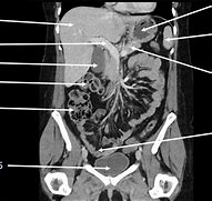 Image result for Abdomen CT Cor