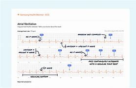 Image result for Bigeminy PVC ECG