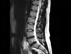 Image result for MRI Scan Lower Back