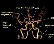 Image result for CT Angiogram Brain Anatomy