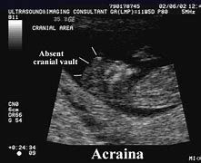 Image result for Anencephaly Ultrasound