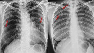 Image result for Chest X-ray of TB