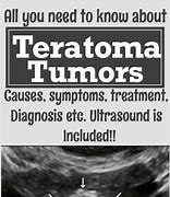 Image result for teratoma symptoms