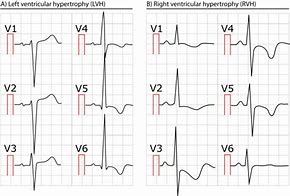 Image result for Right Ventricular Hypertrophy Echo