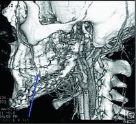 Image result for CTA Scan of Neck