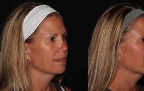 Image result for Chin Correction Filler