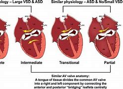 Image result for AV Canal Defect Down Syndrome