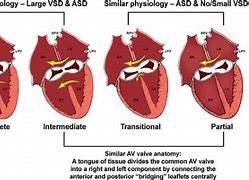 Image result for Tof with Atrioventricular Canal Defect