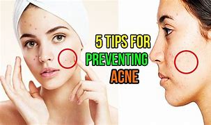 Image result for How to Prevent Pimples On Face