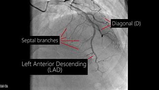 Image result for Coronary Artery Angiography