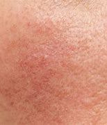 Image result for Redness or Inflammation