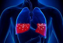 Image result for Acute Pulmonary Oedema and Fluid Overload