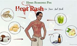 Image result for Soap for Heat Rash