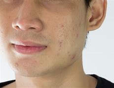 Image result for Itchy Face with Pimples