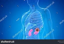 Image result for Kidney Cancer Tumor