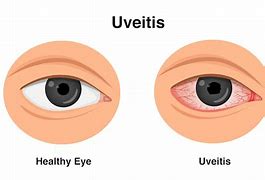 Image result for Uveitis Eye Disease