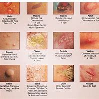 Image result for Pustule Rashes