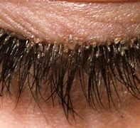 Image result for Eyelash Mites Symptoms