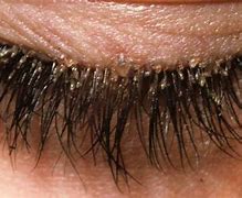 Image result for Human Eyelash Mites